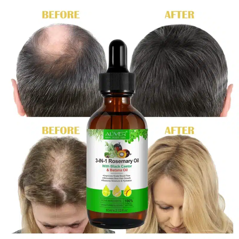 Homepage 24 Hair Loss 3 In 1 Formula of Batana Oil + Rosemary Oil + Black Castor Oil before after